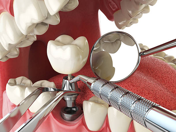 Best Emergency Dentist for Knocked-Out Tooth in Sans Souci, SC